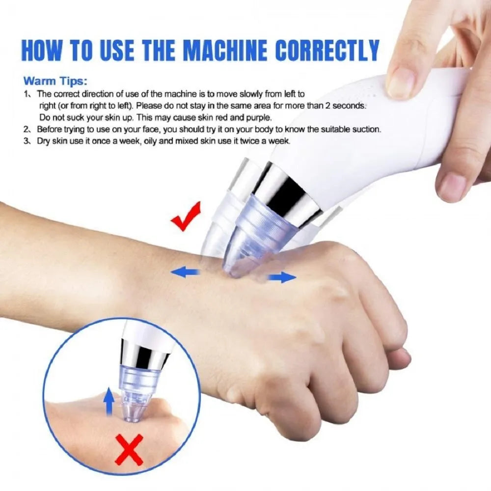 4 in 1 Derma Vacuum Suction Blackhead/Acne/Oil/Pore Cleaner 🌞💁‍♀️