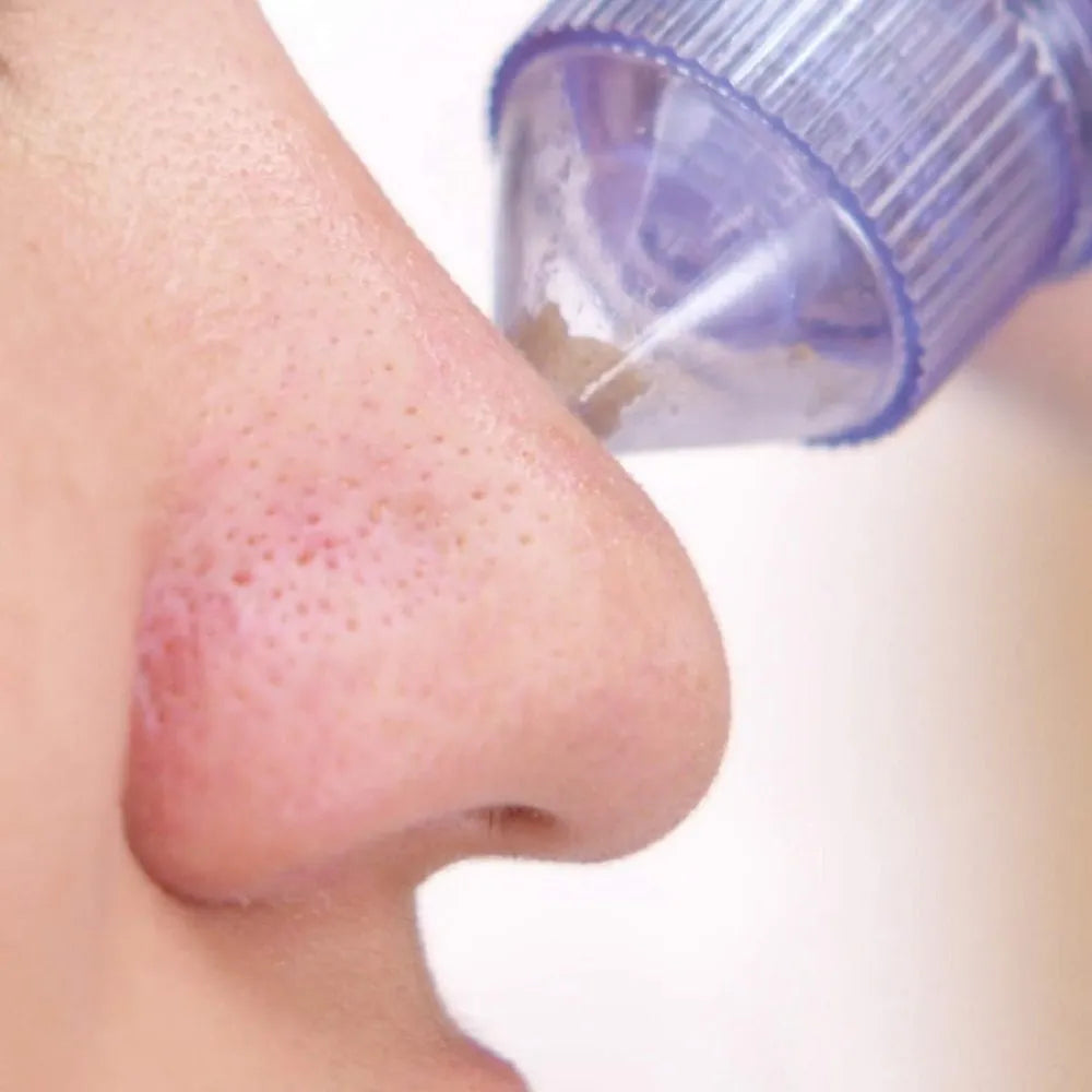 4 in 1 Derma Vacuum Suction Blackhead/Acne/Oil/Pore Cleaner 🌞💁‍♀️