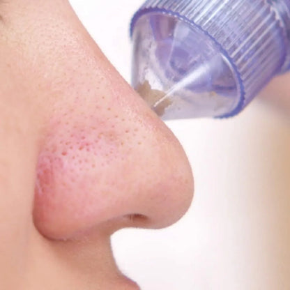 4 in 1 Derma Vacuum Suction Blackhead/Acne/Oil/Pore Cleaner 🌞💁‍♀️